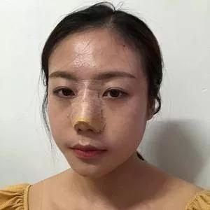 重庆万家燕王珍祥鼻部手术怎么样?案例分享