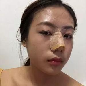 重庆万家燕王珍祥鼻部手术怎么样?案例分享