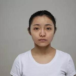重庆华美高伟做下颌角怎么样?案例分享