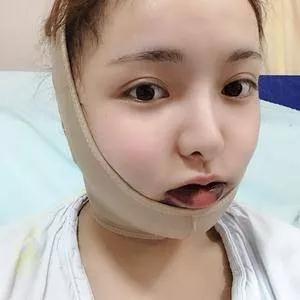 重庆华美高伟做下颌角怎么样?案例分享