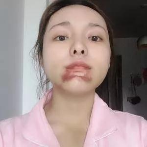 重庆华美高伟做下颌角怎么样?案例分享