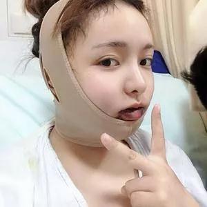 重庆华美高伟做下颌角怎么样?案例分享