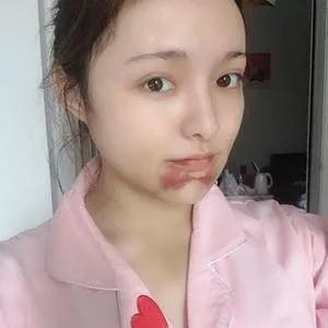重庆华美高伟做下颌角怎么样?案例分享