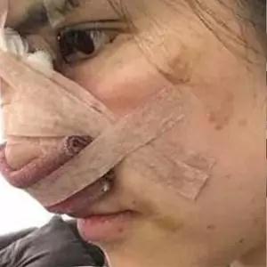南京美贝尔黄名斗眼鼻部手术怎么样?案例分享