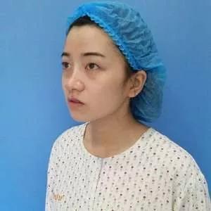 南京美贝尔黄名斗眼鼻部手术怎么样?案例分享