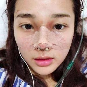 重庆军科范文亮鼻部手术怎么样?案例分享