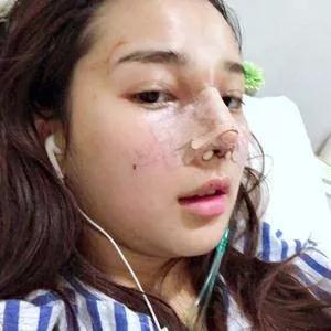 重庆军科范文亮鼻部手术怎么样?案例分享