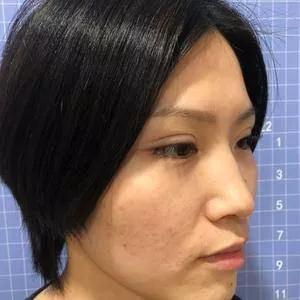苏州康美陈勇鼻部手术怎么样?案例分享