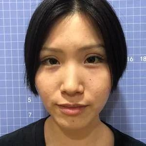 苏州康美陈勇鼻部手术怎么样?案例分享