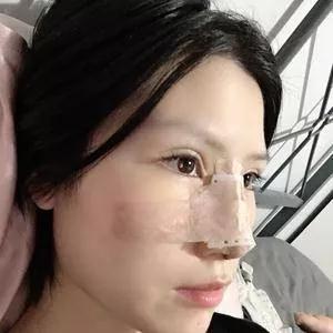 苏州康美陈勇鼻部手术怎么样?案例分享