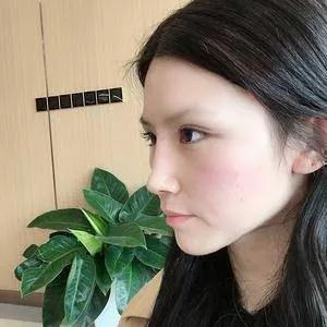 苏州康美陈勇鼻部手术怎么样?案例分享