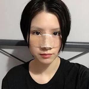 苏州康美陈勇鼻部手术怎么样?案例分享
