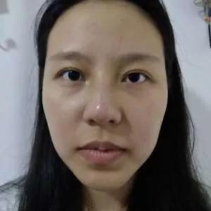 深圳南雅姚成红鼻部手术怎么样?案例分享