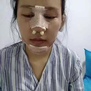 深圳南雅姚成红鼻部手术怎么样?案例分享