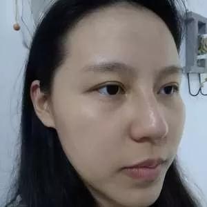 深圳南雅姚成红鼻部手术怎么样?案例分享