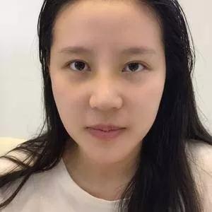 深圳南雅姚成红鼻部手术怎么样?案例分享