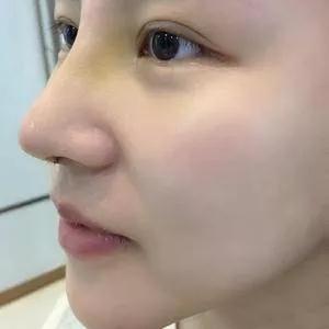深圳南雅姚成红鼻部手术怎么样?案例分享
