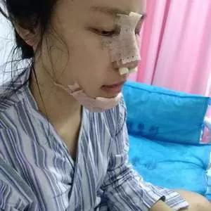 深圳南雅姚成红鼻部手术怎么样?案例分享