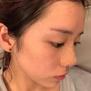 成都铜雀台雷刚鼻部手术怎么样?案例分享