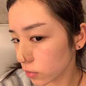 成都铜雀台雷刚鼻部手术怎么样?案例分享
