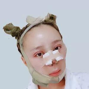 杭州时光陈小平眼部手术+鼻部手术+下颌角怎么样?案例分享