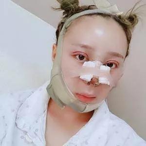 杭州时光陈小平眼部手术+鼻部手术+下颌角怎么样?案例分享