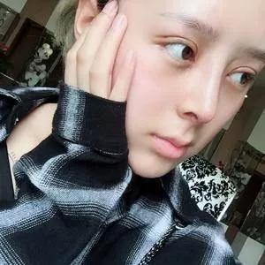杭州时光陈小平眼部手术+鼻部手术+下颌角怎么样?案例分享