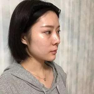 苏州吴中维多利亚端木雪峰眼修复怎么样?案例分享