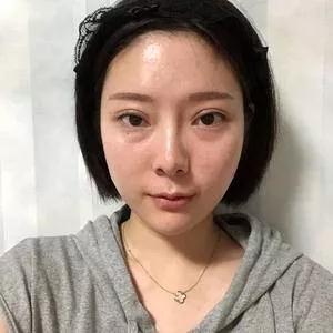 苏州吴中维多利亚端木雪峰眼修复怎么样?案例分享