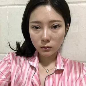 苏州吴中维多利亚端木雪峰眼修复怎么样?案例分享
