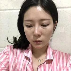 苏州吴中维多利亚端木雪峰眼修复怎么样?案例分享