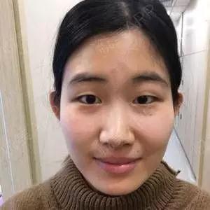 北京叶美人丁雅晴眼鼻部手术怎么样?案例分享