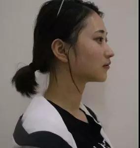 北京华悦府王宁博埋线双眼皮怎么样?案例分享