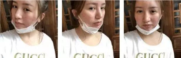 成都西区黄富伟鼻部手术怎么样?案例分享