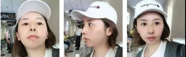 成都西区黄富伟鼻部手术怎么样?案例分享