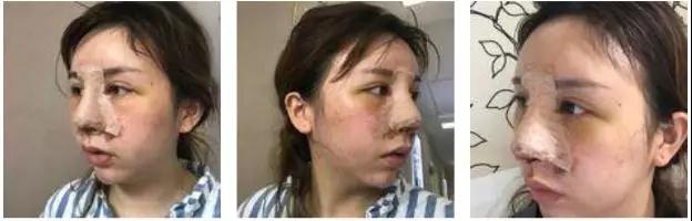 成都西区黄富伟鼻部手术怎么样?案例分享