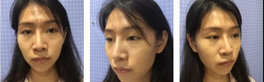苏州康美张悦迪全切双眼皮怎么样?案例分享