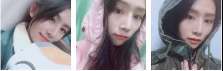 苏州康美张悦迪全切双眼皮怎么样?案例分享
