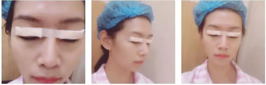 苏州康美张悦迪全切双眼皮怎么样?案例分享