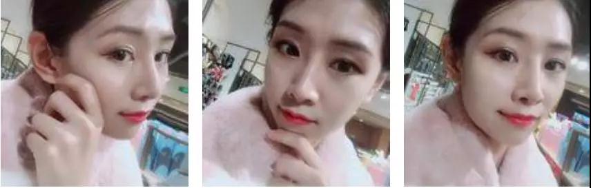 苏州康美张悦迪全切双眼皮怎么样?案例分享