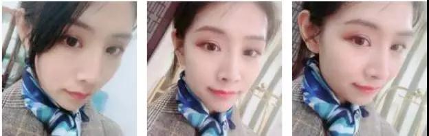 苏州康美张悦迪全切双眼皮怎么样?案例分享