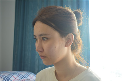 沈阳盛京尚美王超自体脂肪全脸填充怎么样?案例分享