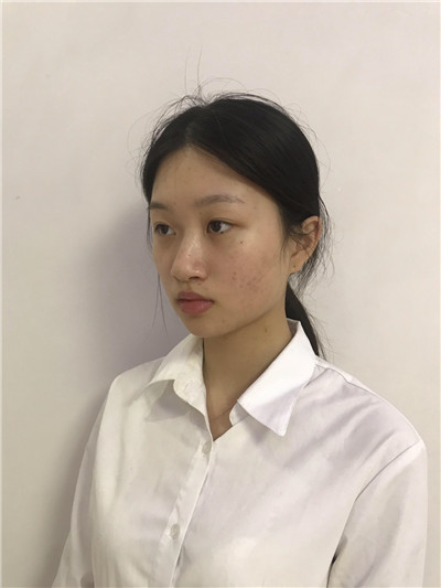 四川悦好胡纯兵鼻部手术怎么样?案例分享