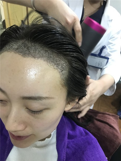 济南熙朵葛瑞瑞种植发际线怎么样?案例分享