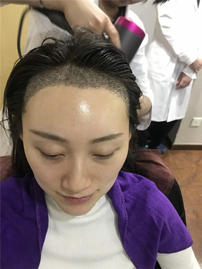 济南熙朵葛瑞瑞种植发际线怎么样?案例分享
