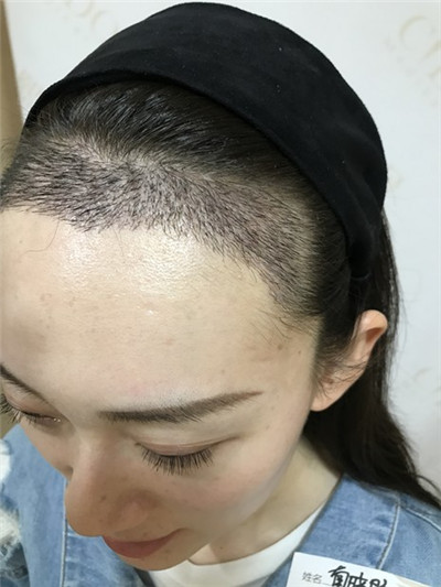 济南熙朵葛瑞瑞种植发际线怎么样?案例分享