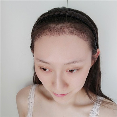 济南熙朵葛瑞瑞种植发际线怎么样?案例分享