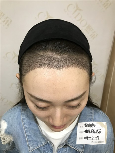 济南熙朵葛瑞瑞种植发际线怎么样?案例分享