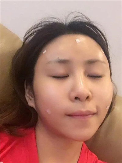 南宁悦星钟贵红自体脂肪全脸填充怎么样?案例分享