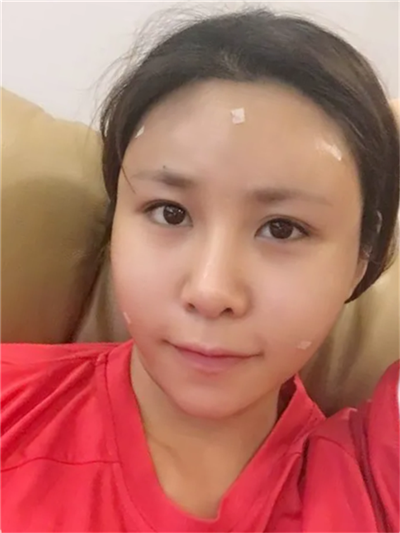 南宁悦星钟贵红自体脂肪全脸填充怎么样?案例分享